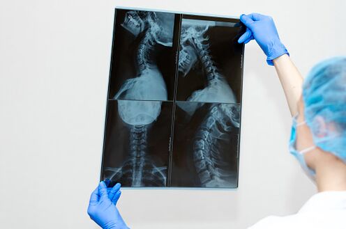 Osteochondrosis Wirbelsäulenerkrankungen