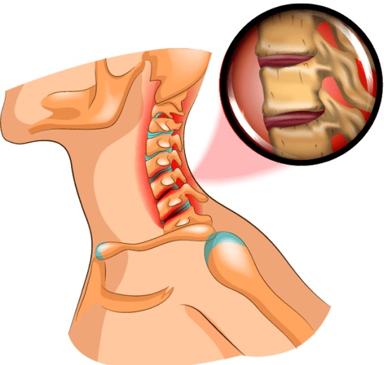 Osteochondrose im Nacken