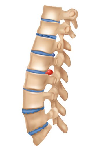 Wie sieht die Deophring -Osteochondrose aus